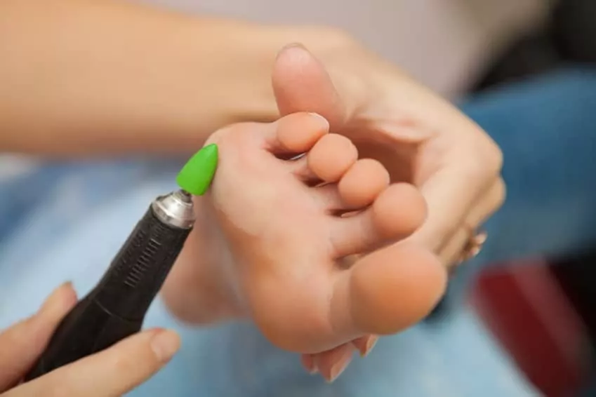 Eliminación de callos y durezas